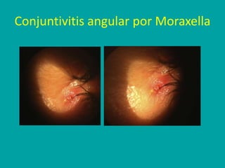Conjuntivitis angular por Moraxella
 