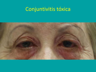 Conjuntivitis tóxica
 