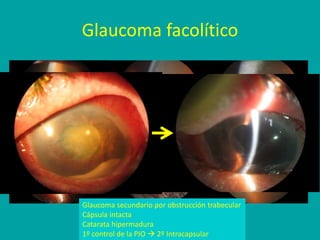 Glaucoma facolítico
Glaucoma secundario por obstrucción trabecular
Cápsula intacta
Catarata hipermadura
1º control de la PIO  2º Intracapsular
 