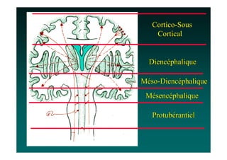 Cortico-Sous
    Cortical


  Diencéphalique

Méso-Diencéphalique
 Mésencéphalique

   Protubérantiel
 