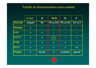Echelle de déstructuration rostro-caudale


              CSC         D        M-D      M          P
Motricité     Adaptée    FD      FD ou ED FD ou ED   ED ou 0

Mimique         +         -         -        -          -
VOV             +         +         -        -          -
RPM             +         +         +        -          -
VOH             +         +         +        +          -
ROC             +         +         +        +         +/-
Pupilles         I      myosis      I     mydriase   punctif
 