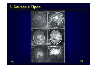 3. Causas e Tipos




TPA                 20
 