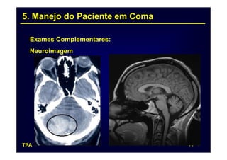 5. Manejo do Paciente em Coma

  Exames Complementares:
  Neuroimagem




TPA                             63
 