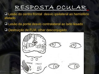 RESPOSTA OCULAR   Lesão do centro frontal  desvio ipsilateral ao hemisfério afetado Lesão da ponte desvio contralateral ao lado lesado Destruição de FLM, olhar desconjugado 