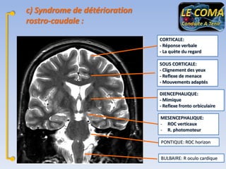 c) Syndrome de détérioration
rostro-caudale :
CORTICALE:
- Réponse verbale
- La quète du regard
SOUS CORTICALE:
- Clignement des yeux
- Reflexe de menace
- Mouvements adaptés
DIENCEPHALIQUE:
- Mimique
- Reflexe fronto orbiculaire
MESENCEPHALIQUE:
- ROC verticaux
- R. photomoteur
PONTIQUE: ROC horizon
BULBAIRE: R oculo cardique

 