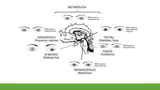 Exame neurológico
Motricidade ocular intrínseca ou pupilar
 Observamos o diâmetro ad pupila e RFM
 