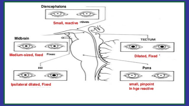 cn iii compression and fixed dilated pupil cn iii compression and fixed dilated pupil