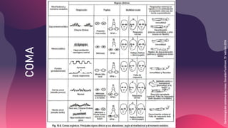 Coma y alteracion del estado de conciencia | PPTX