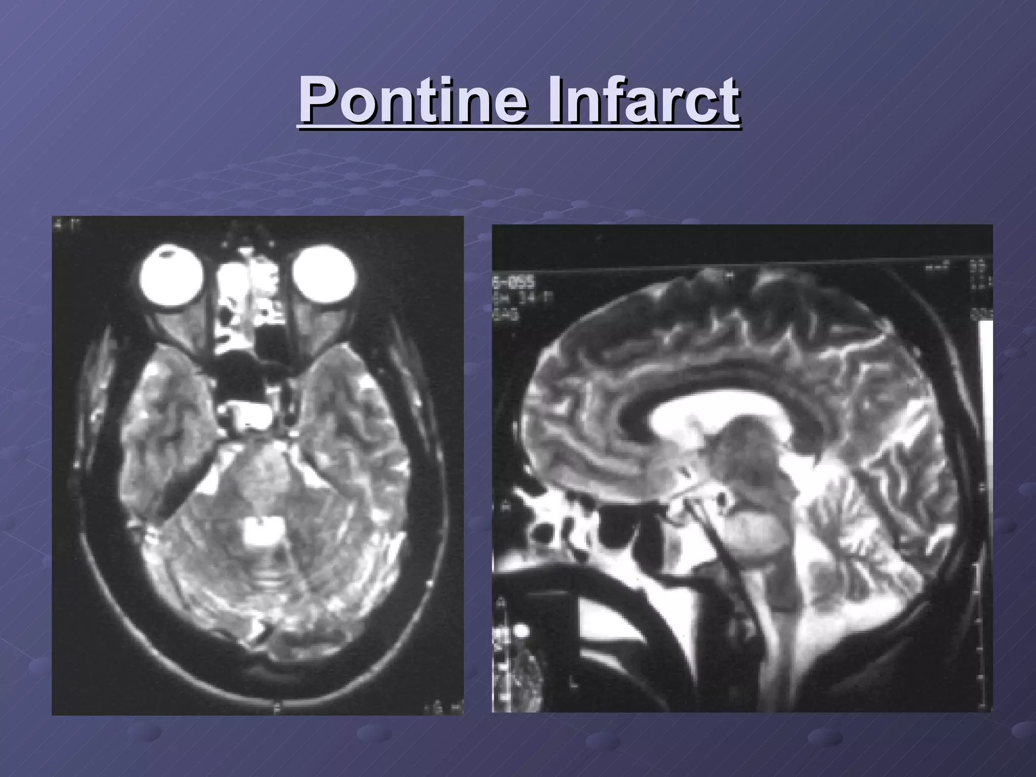 Pontine Infarct 