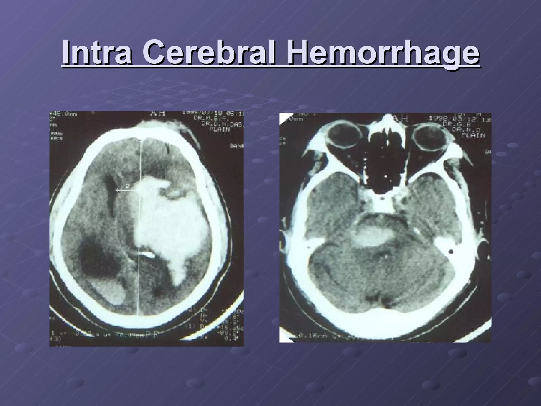 Intra Cerebral Hemorrhage 