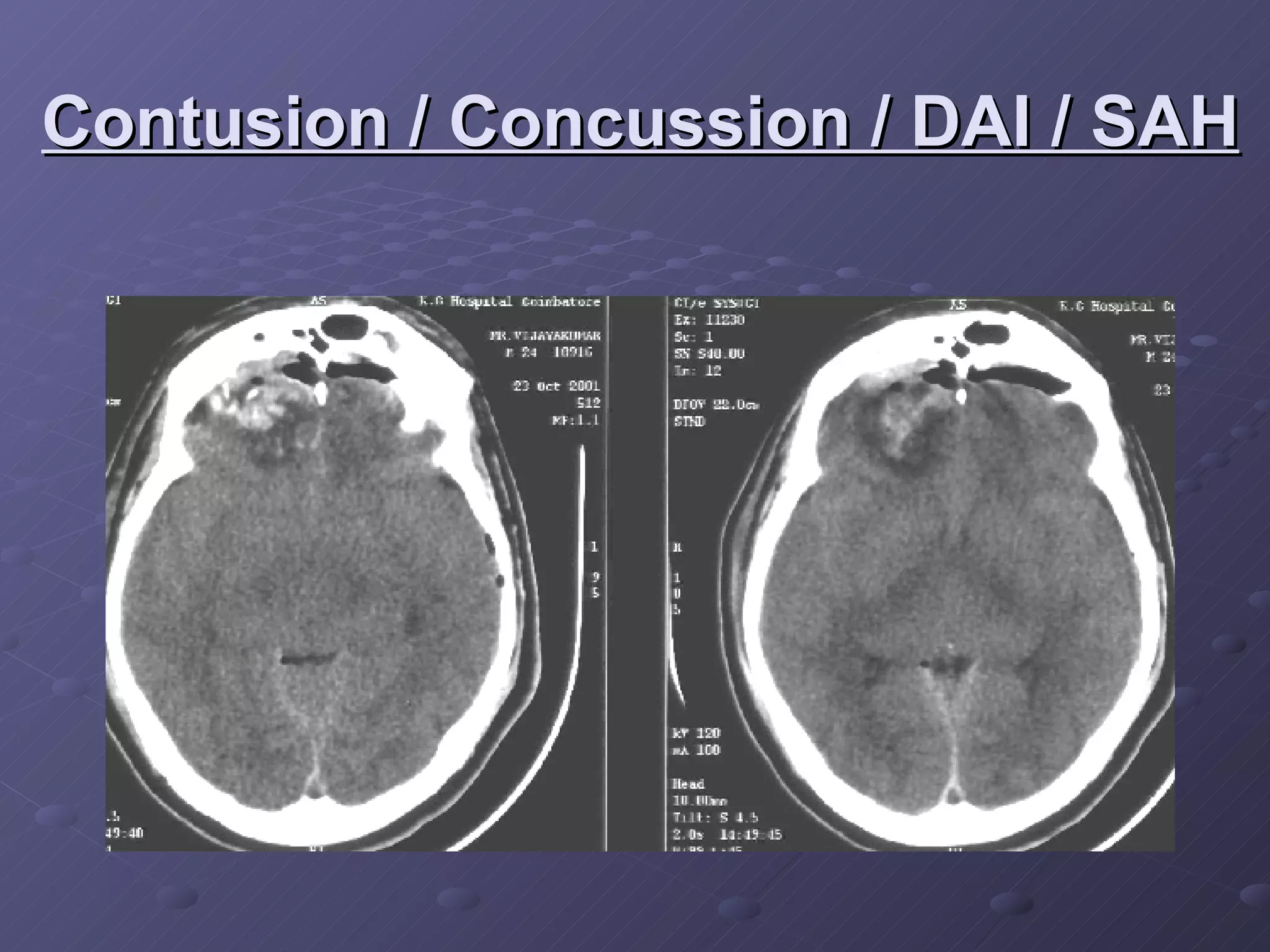 Contusion / Concussion / DAI / SAH 
