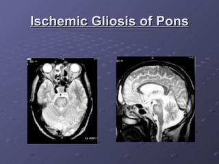 Ischemic Gliosis of Pons 