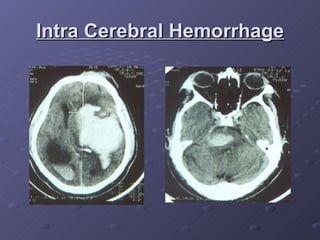 Intra Cerebral Hemorrhage 