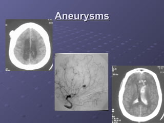 Aneurysms 
