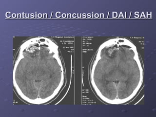Contusion / Concussion / DAI / SAH 