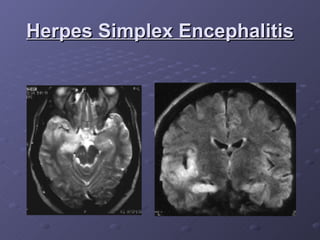 Herpes Simplex Encephalitis 