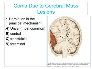 Coma Due to Cerebral Mass
Lesions
• Herniation is the
principal mechanism
A) Uncal (most common)
B) central
C) transfalcial
D) foraminal
 