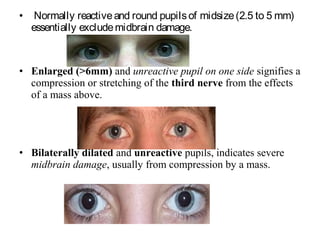 • Normally reactiveand round pupilsof midsize(2.5 to 5 mm)
essentially excludemidbrain damage.
• Enlarged (>6mm) and unreactive pupil on one side signifies a
compression or stretching of the third nerve from the effects
of a mass above.
• Bilaterally dilated and unreactive pupils, indicates severe
midbrain damage, usually from compression by a mass.
 