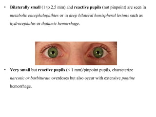 • Bilaterally small (1 to 2.5 mm) and reactive pupils (not pinpoint) are seen in
metabolic encephalopathies or in deep bilateral hemispheral lesions such as
hydrocephalus or thalamic hemorrhage.
• Very small but reactive pupils (< 1 mm)/pinpoint pupils, characterize
narcotic or barbiturate overdoses but also occur with extensive pontine
hemorrhage.
 