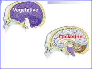 Vegetative
Locked-in
 