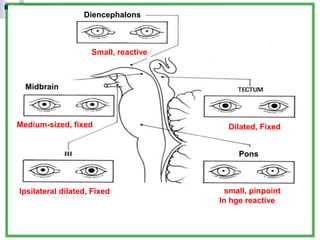 Small, reactive
Diencephalons
Dilated, Fixed
small, pinpoint
In hge reactive
Pons
Midbrain
Ipsilateral dilated, Fixed
Medium-sized, fixed
.
 