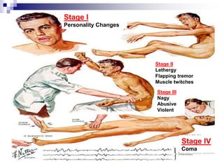 Stage I
Personality Changes
Stage II
Lethergy
Flapping tremor
Muscle twitches
Stage III
Nagy
Abusive
Violent
Stage IV
Coma
 