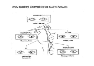 NIVEAU DES LESIONS CEREBRALES SELON LE DIAMETRE PUPILLAIRE
 