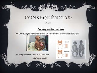 CONSEQUÊNCIAS:
Consequências da fome:
 Desnutrição - Devido à falta de nutrientes, proteínas e calorias.
 Raquitismo - devido à carência
de Vitamina D.
 
