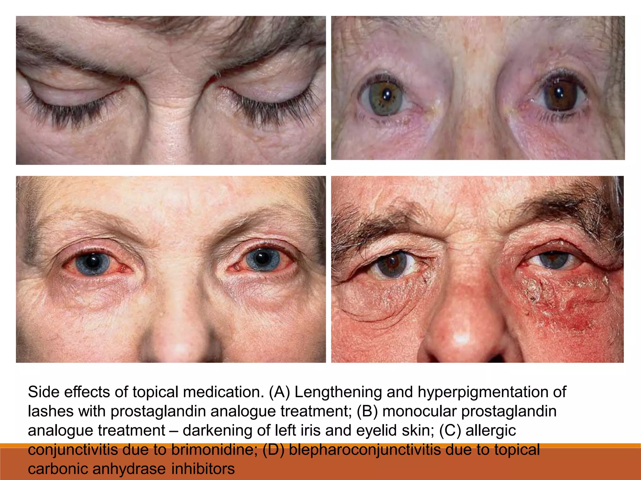 Combination medication glaucoma