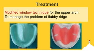 Treatment
Modified window technique for the upper arch
To manage the problem of flabby ridge
 