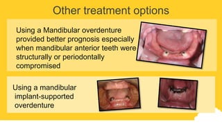 Other treatment options
Using a Mandibular overdenture
provided better prognosis especially
when mandibular anterior teeth were
structurally or periodontally
compromised
Using a mandibular
implant-supported
overdenture
 