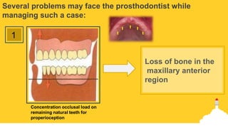 Several problems may face the prosthodontist while
managing such a case:
Concentration occlusal load on
remaining natural teeth for
properioception
1
Loss of bone in the
maxillary anterior
region
 