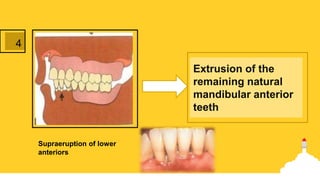 Supraeruption of lower
anteriors
4
Extrusion of the
remaining natural
mandibular anterior
teeth
 
