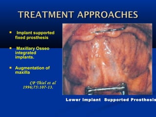  Implant supported
fixed prosthesis
 Maxillary Osseo
integrated
implants.
 Augmentation of
maxilla
CP Thiel et al
1996;75:107-13.  
Lower Implant Supported Prosthesis
 