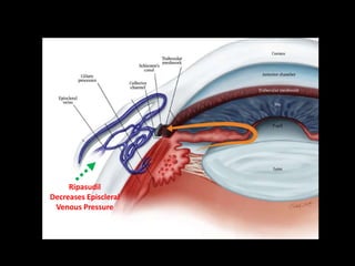 Ripasudil
Decreases Episcleral
Venous Pressure
 
