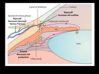 24
Ripasudil
Increases AH outflow
Ripasudil
Decreases Episcleral
Venous Pressure
Timolol
Decreases AH
production
 