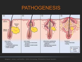 Combination therapy for recurrent acne | PPTX