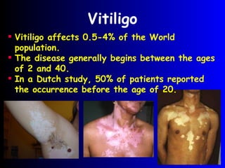 Vitiligo Vitiligo affects 0.5-4% of the World population. The disease generally begins between the ages of 2 and 40. In a Dutch study, 50% of patients reported the occurrence before the age of 20. 