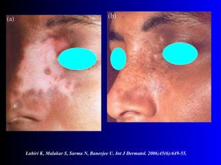 Lahiri K, Malakar S, Sarma N, Banerjee U. Int J Dermatol. 2006;45(6):649-55. 