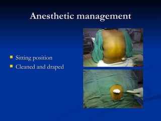 Anesthetic management <ul><li>Sitting position </li></ul><ul><li>Cleaned and draped </li></ul>