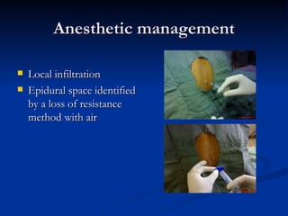 Anesthetic management <ul><li>Local infiltration </li></ul><ul><li>Epidural space identified by a loss of resistance metho...