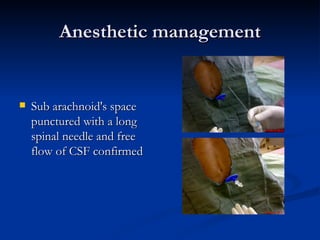 Anesthetic management <ul><li>Sub arachnoid's space punctured with a long spinal needle and free flow of CSF confirmed </l...