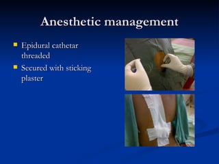 Anesthetic management <ul><li>Epidural cathetar threaded </li></ul><ul><li>Secured with sticking plaster </li></ul>
