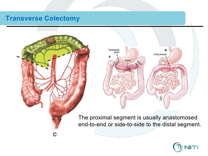 Right And Extended Right Colectomy: Open Technique – EIZNJ