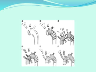 Combined carotid and coronary disease the strategy should be | PPTX