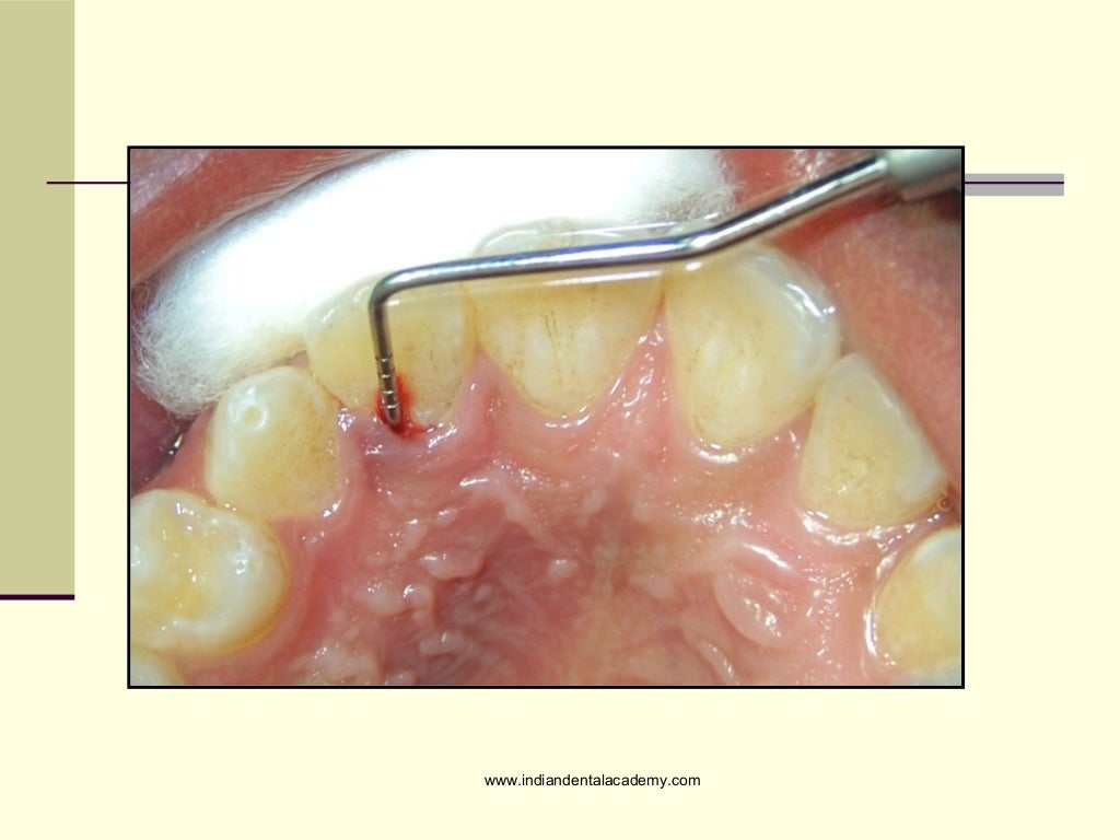 Combined endodontic periodontic treatment of a palatal groove/ dental…