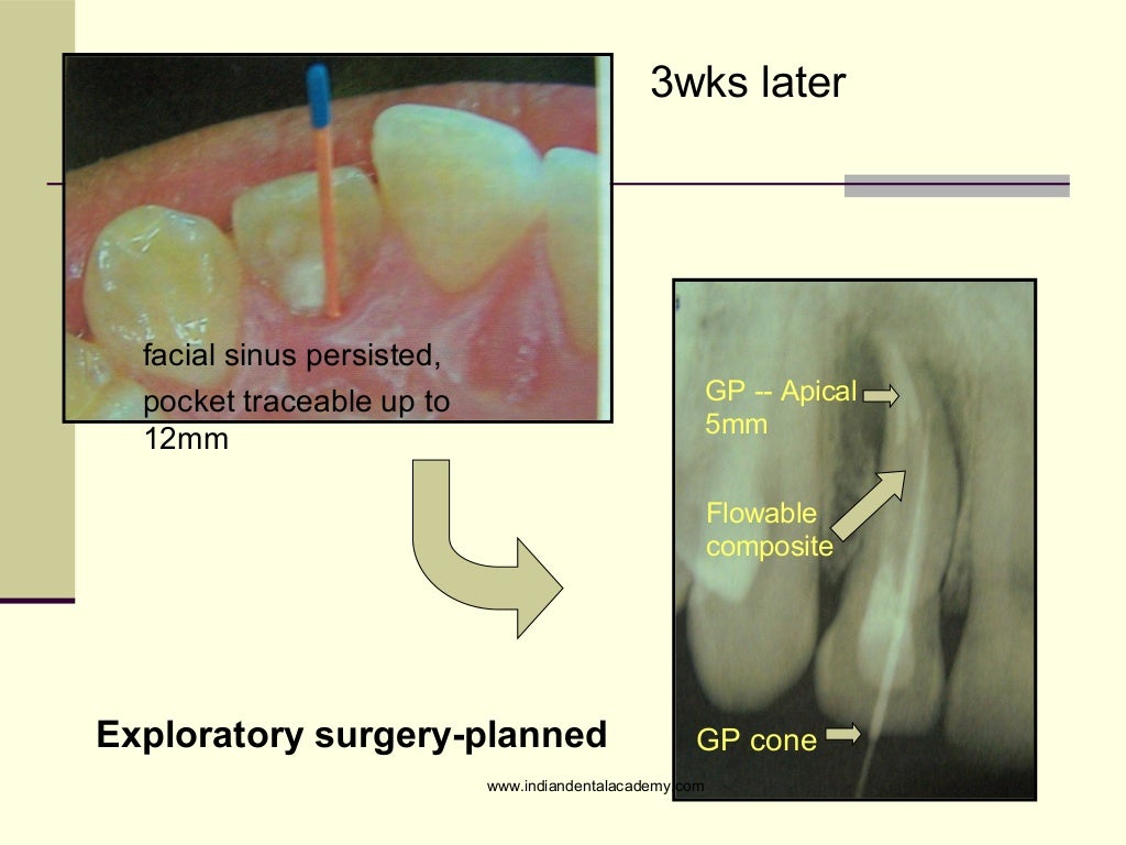 Combined endodontic periodontic treatment of a palatal groove/ dental…