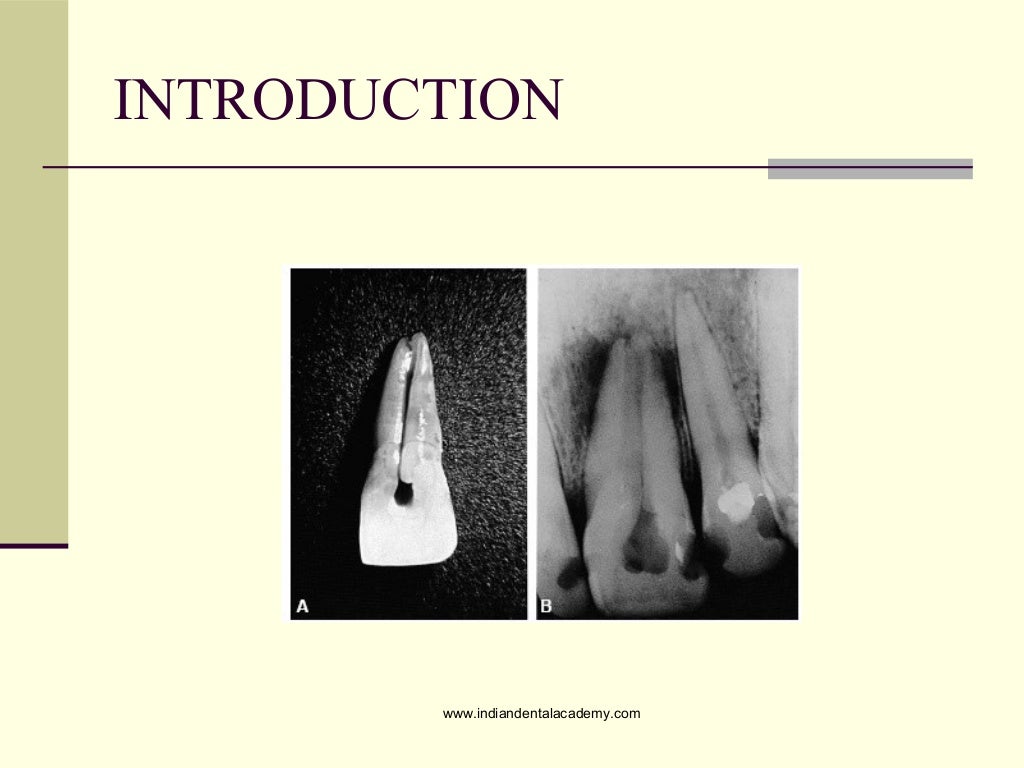 Combined endodontic periodontic treatment of a palatal groove/ dental…