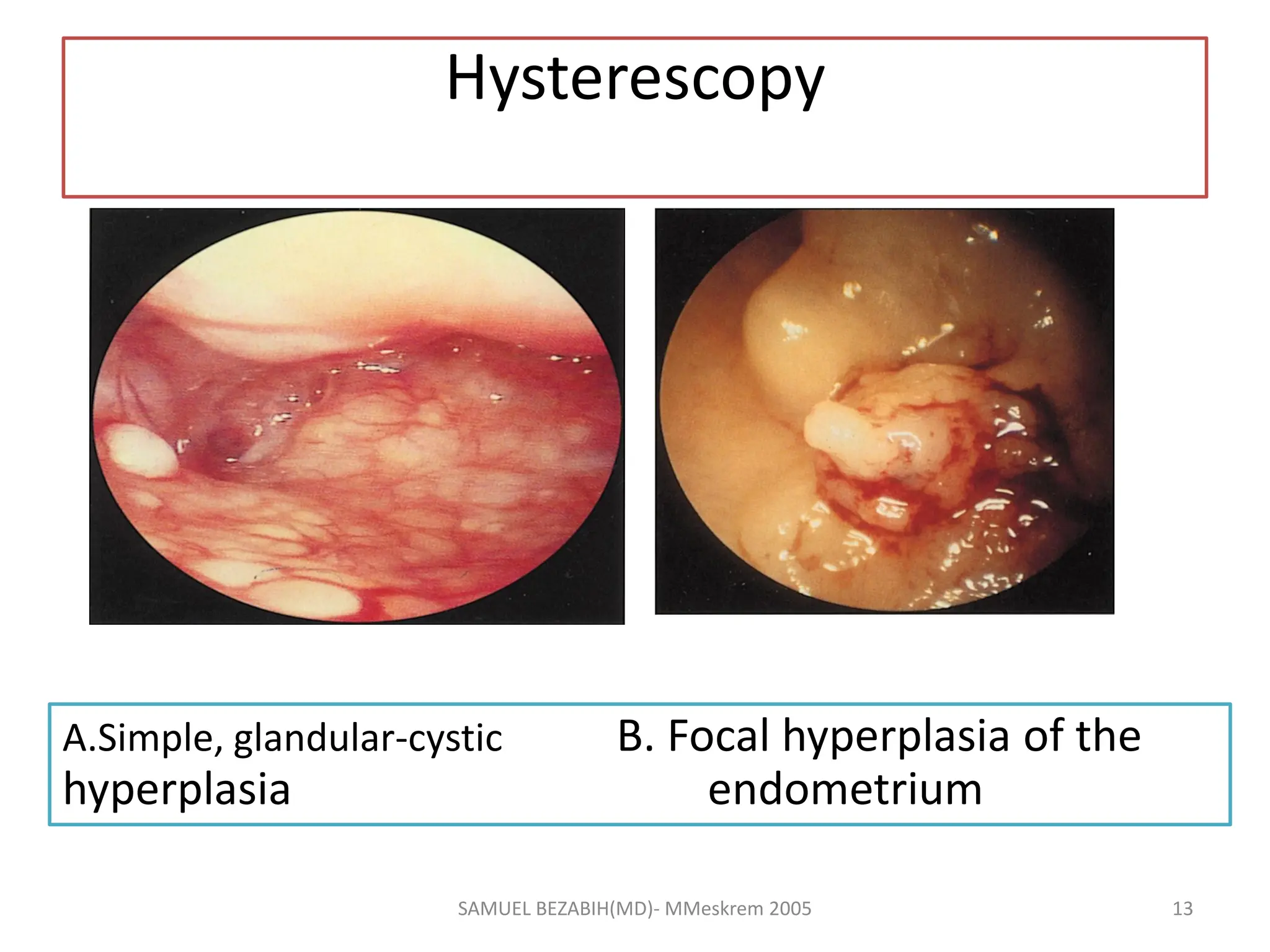 Hysterescopy
A.Simple, glandular-cystic B. Focal hyperplasia of the
hyperplasia endometrium
SAMUEL BEZABIH(MD)- MMeskrem 2005 13
 