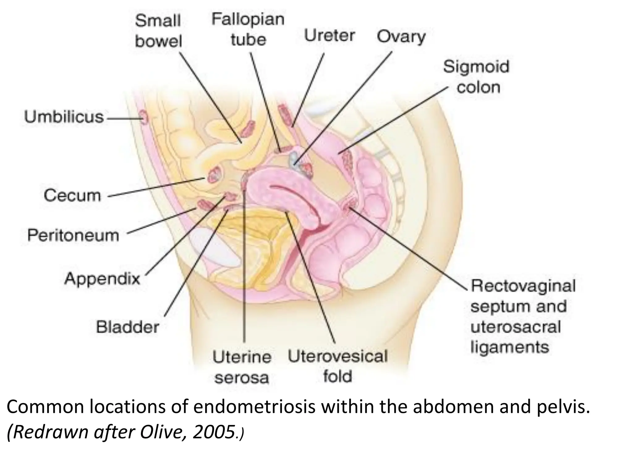 Common locations of endometriosis within the abdomen and pelvis.
(Redrawn after Olive, 2005.)
 